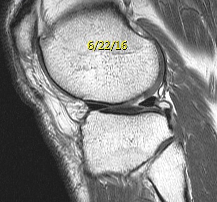 Figure 3 for case Button osteophyte filling chondral defect
